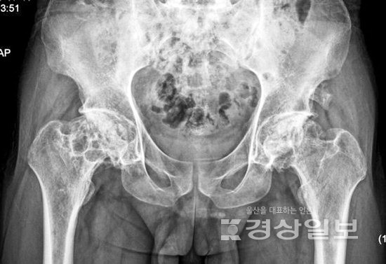 ▲ 대퇴골두 무혈성 괴사 수술 전.