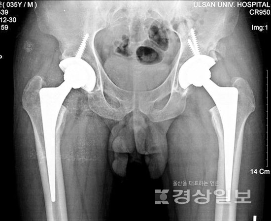 ▲ 대퇴골두 무혈성 괴사 수술 후 모습.